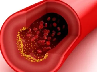 LDL 콜레스테롤 정상수치 낮추는법_4