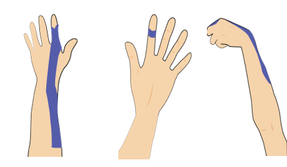 일반적인 손가락 통증의 테이핑요법