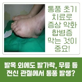 발가락 통풍 증상 및 대처방법_18