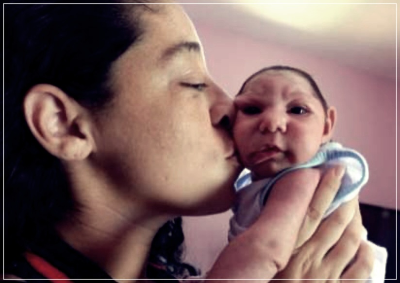 소두증 이란? 원인, 증상, 치료방법들