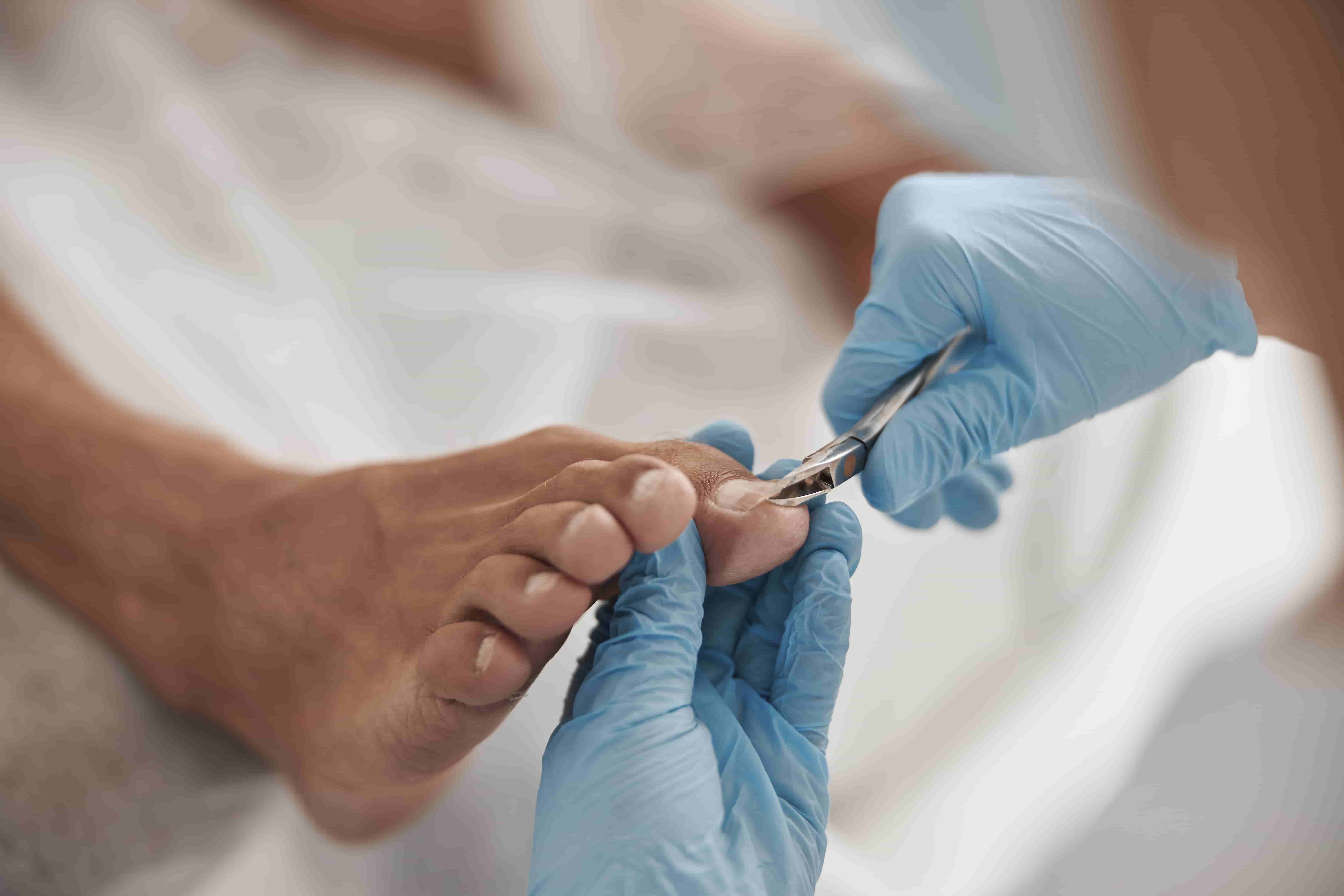 내성 발톱을 치료하고 있는 상황을 촬영한 이미지