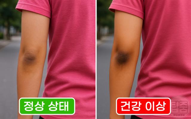 팔꿈치 까만 이유 갑상선 당뇨병 전조증상