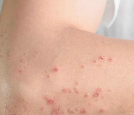 좀벌레 물린자국 퇴치법 원인 집안 화장실 침대 옷장 살충제 트랩 총정리 1