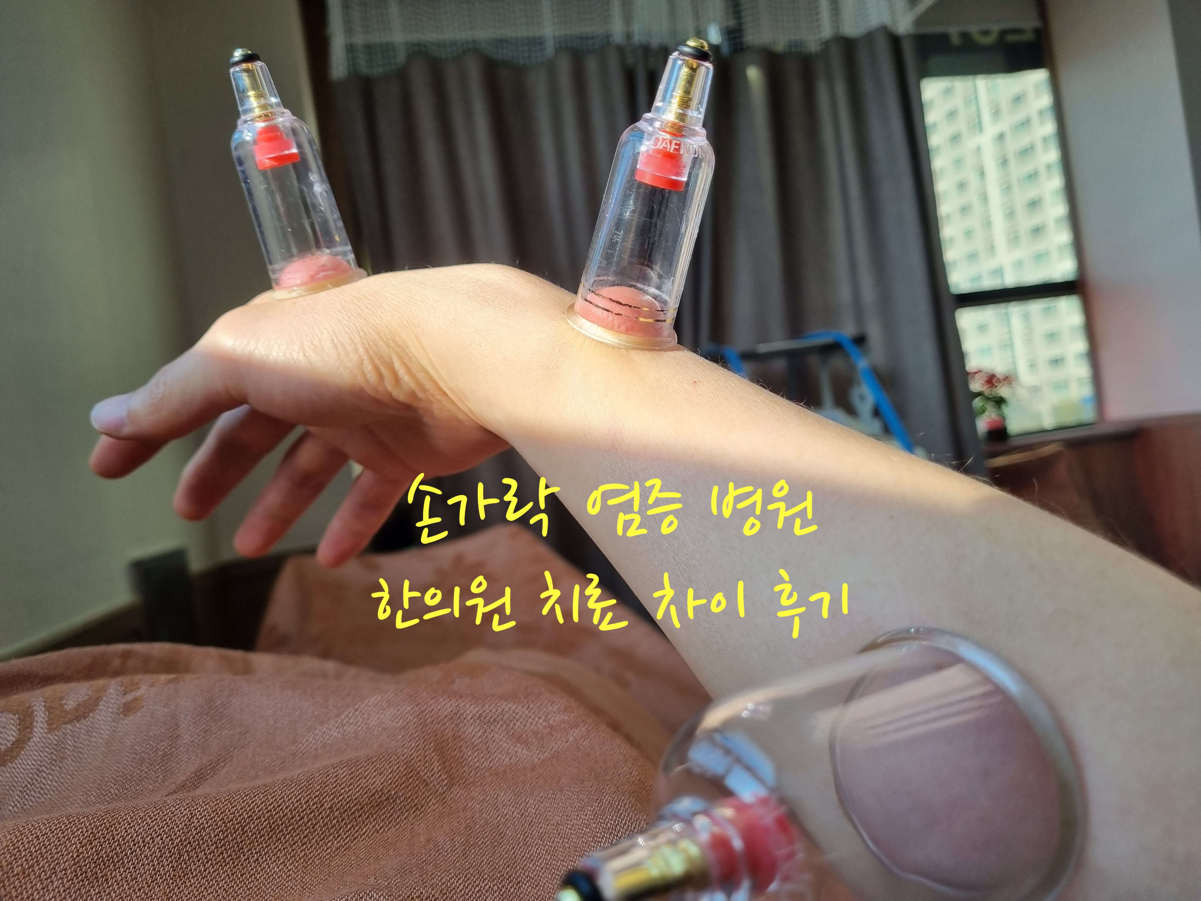 손가락 염증