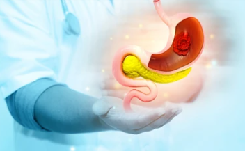 위암 4기 생존율