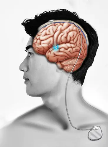 뇌심부자극술로 자극용전극 삽입-모사도