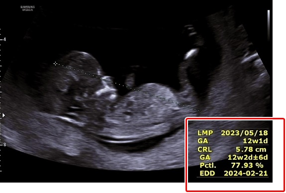 초음파사진12주