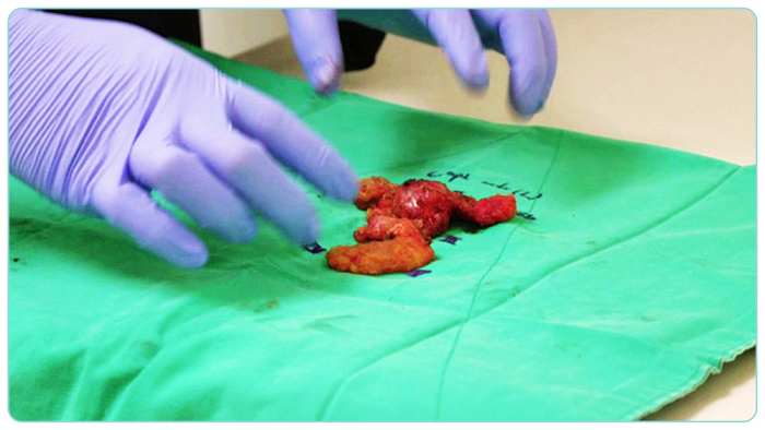 ebs-명의-두경부암-암세포-적출