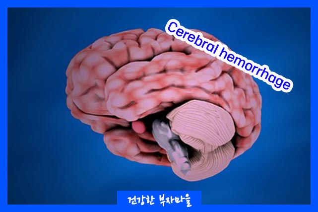 뇌출혈이란?