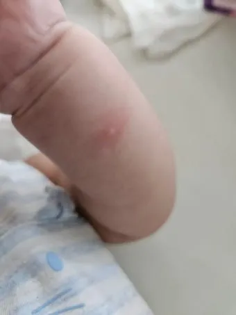 모기 물려 가려울 때 땀띠에 안티푸라민 연고 효능 부작용 사용후기_13