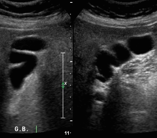 담낭의 정상변이 (normla variation)