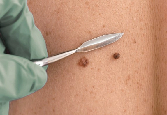 흑색종 치료법과 예후