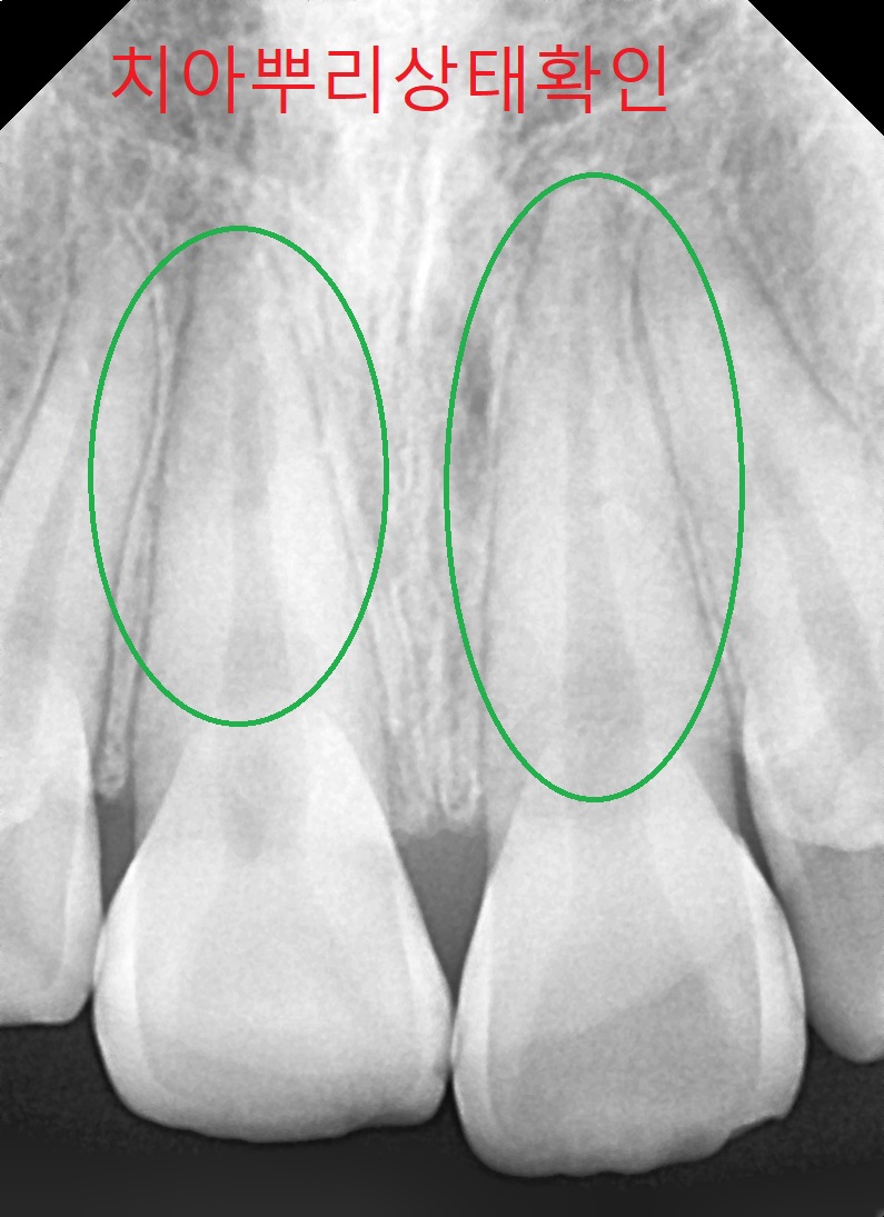 부정교합 가위교합 과개교합 치아교정 후기4