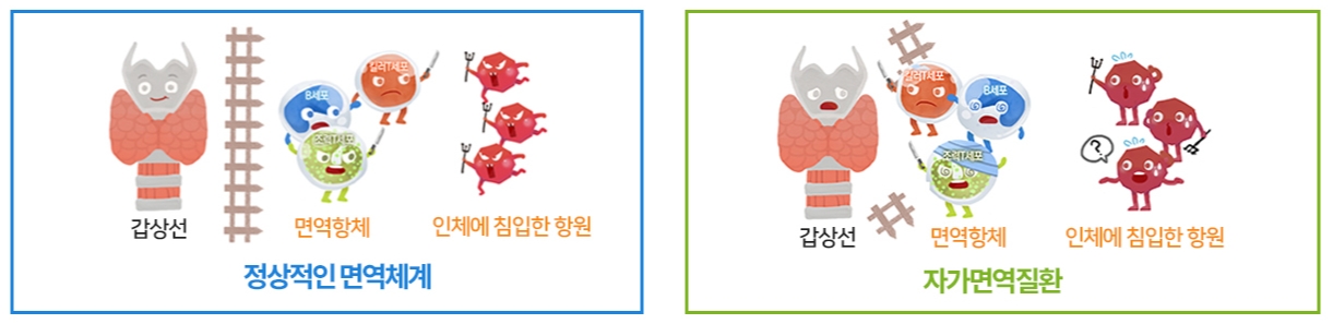 갑상선기능저하증