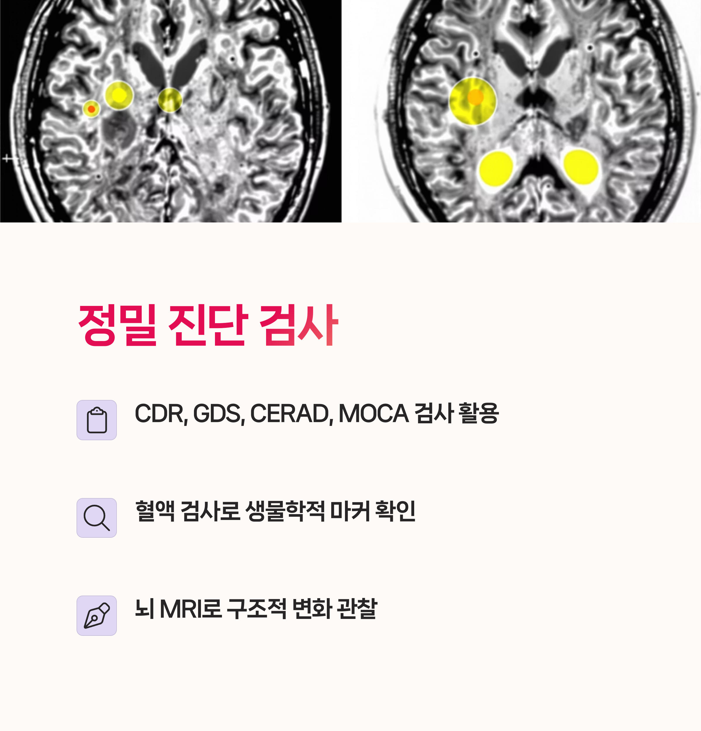 MRI치매예측, 백질변화분석,