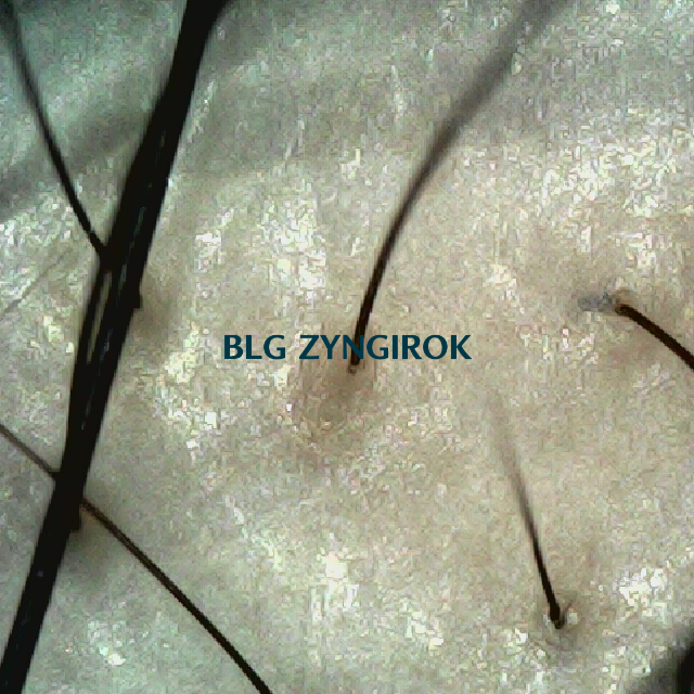 탈모 극복 프로젝트 - 정수리와 이마 사이 두피모습이다.