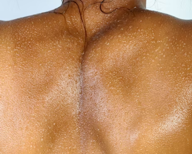 피부 리프팅 시술 가격