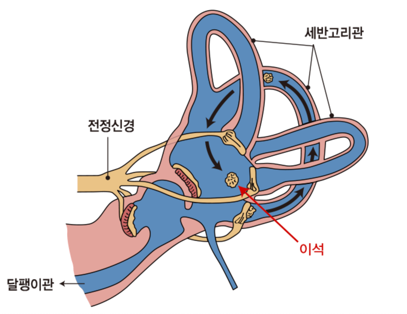 이석증 원인