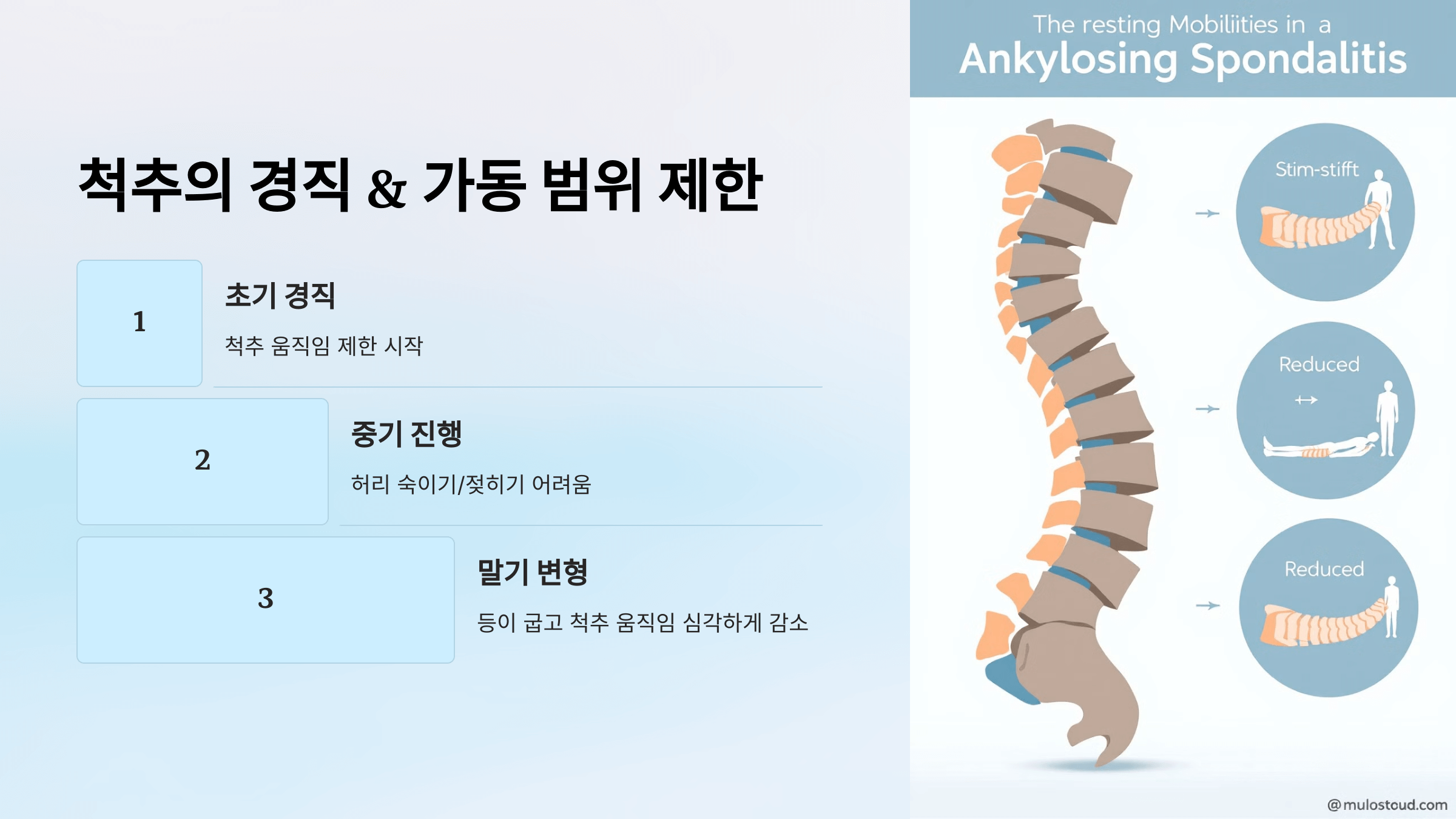 강직성 척추염과 관련된 사진입니다.