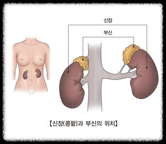 쿠싱증후군