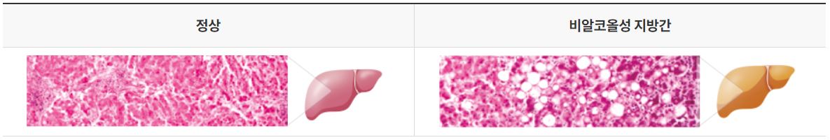 비알코올성지방간과-정상간을-비교한-사진