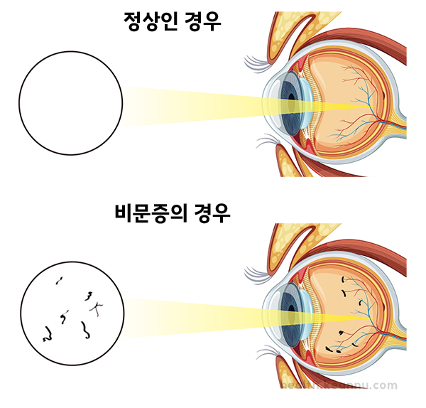 비문증