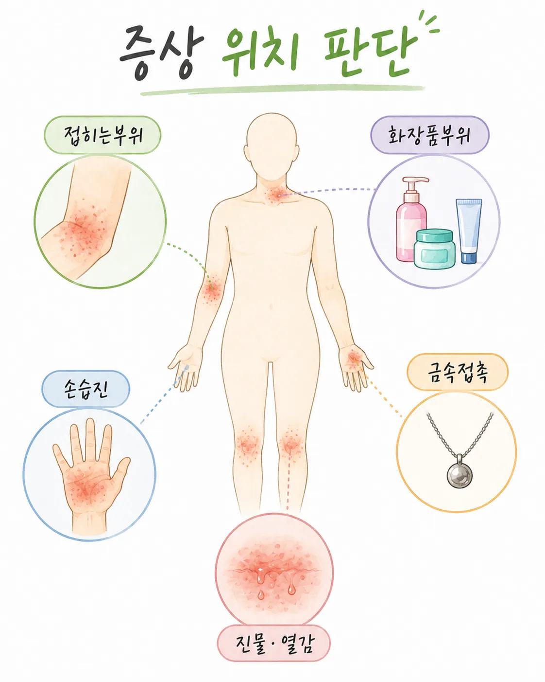 피부염 증상 위치 판단표