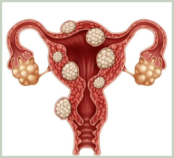 자궁근종 원인 및 증상