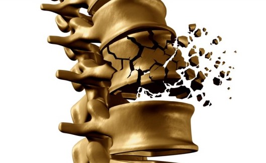 일러스트로-그린-척추뼈가-압박골절되는-사진