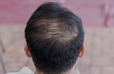 탈모 원인과 예방법, 탈모 예방 샴푸