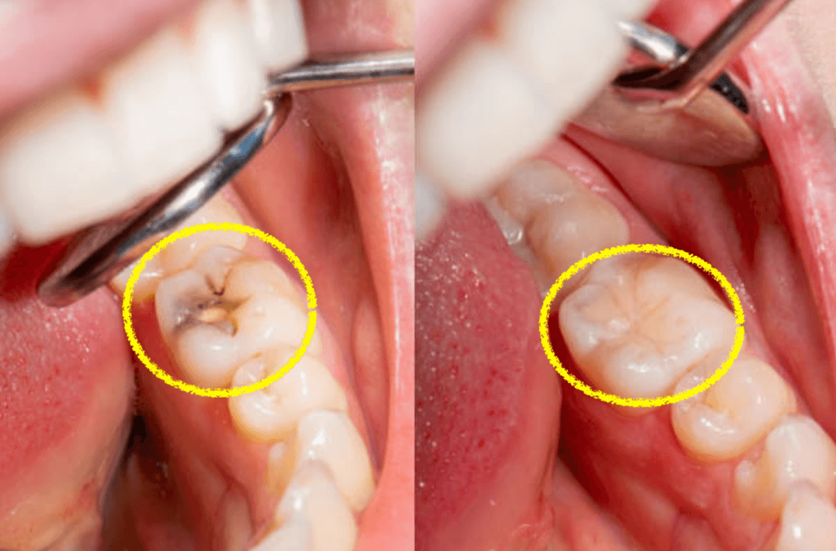 충치 레진 치료