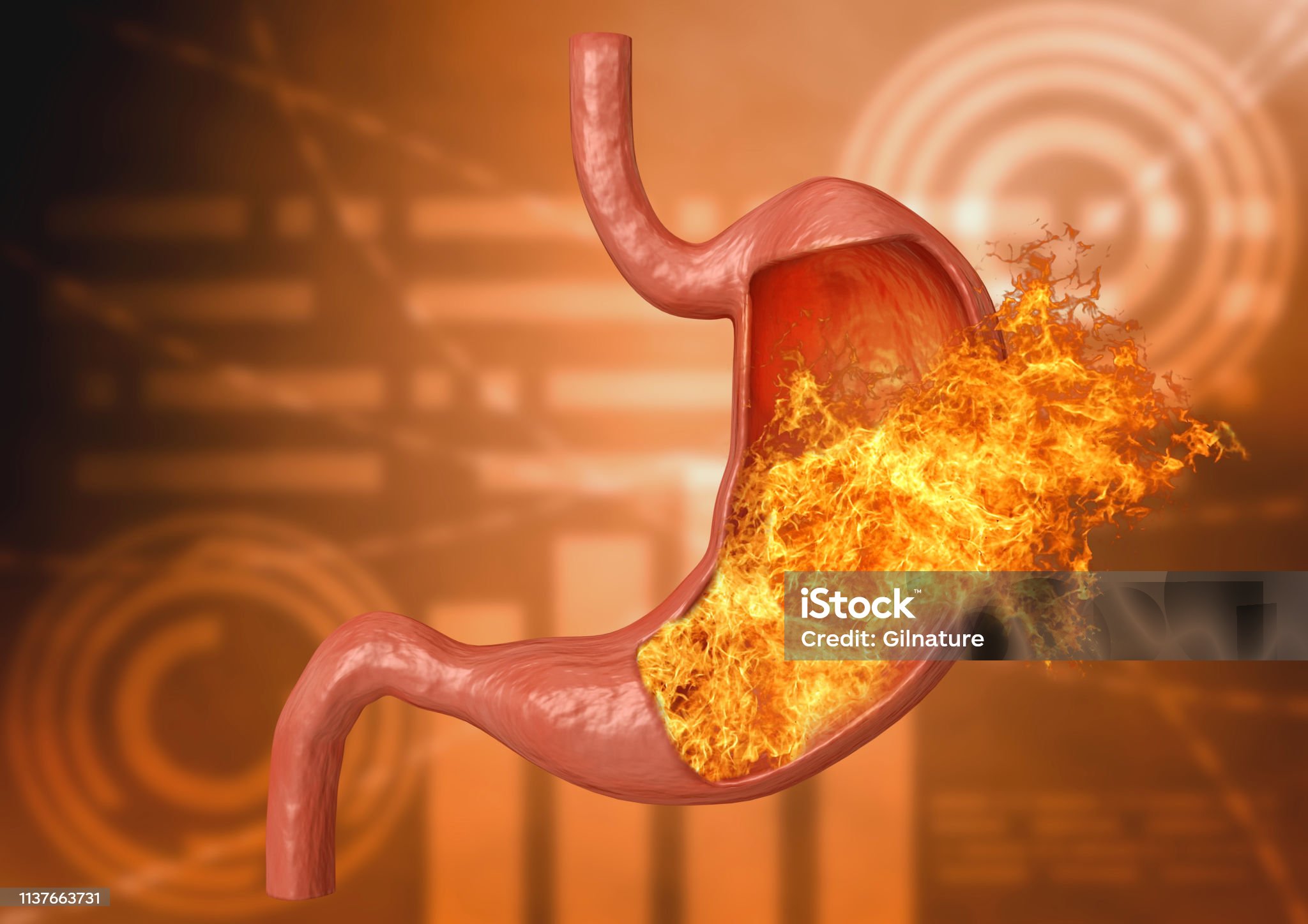 위궤양-관련-사진