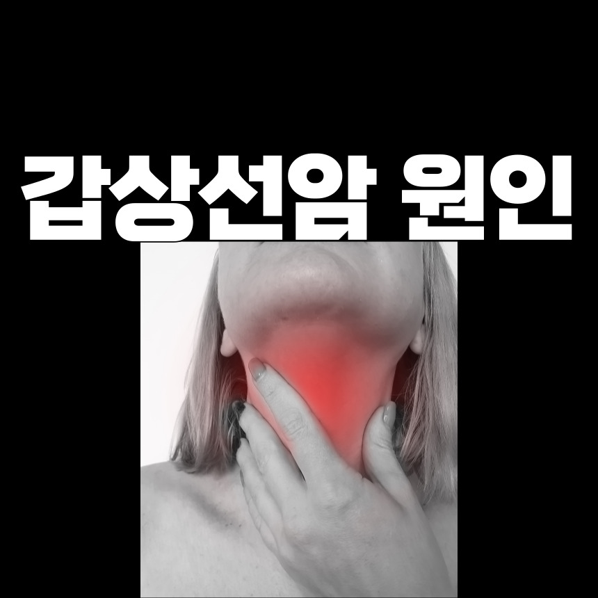 갑상선암 원인