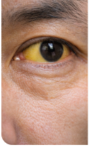 간수치가 높으면 나타나는 증상