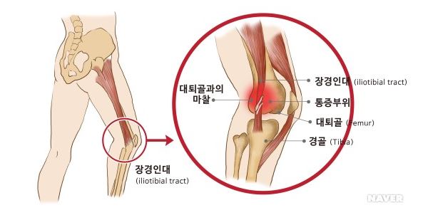 장경인대증후군