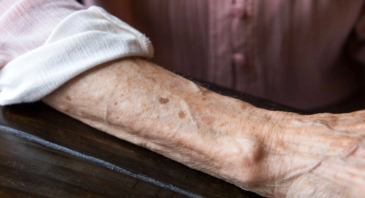 검버섯 없애는 방법