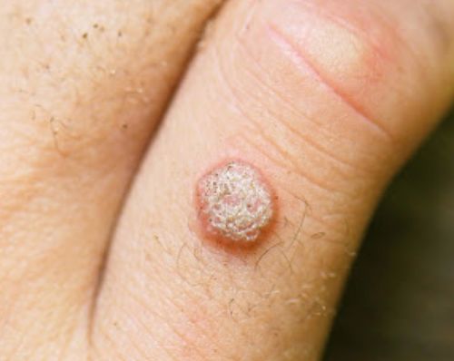 손등 편평사마귀