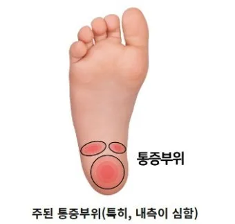 발바닥통증의 원인들과 해결책_24