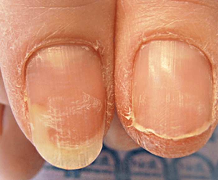 손톱 갈라짐의 이유