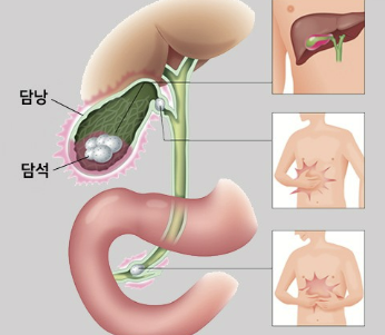 담낭염의 증상, 제거 수술, 치료 원인 좋은 음식 알아보기