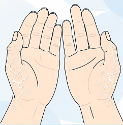 갑상선 기능 저하증