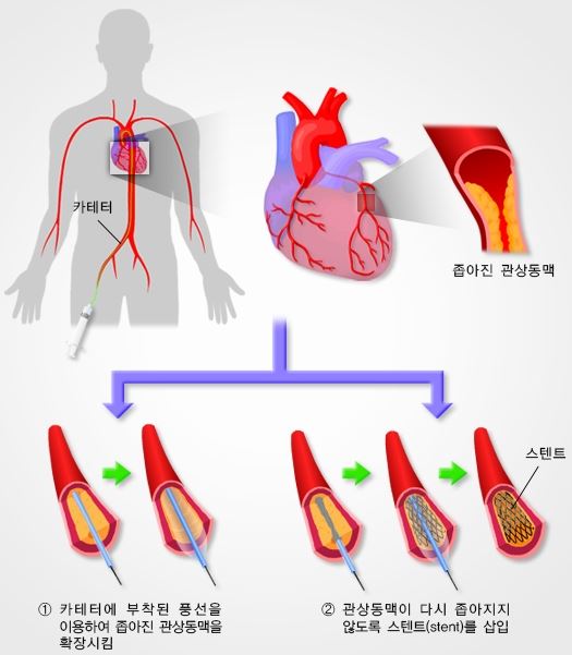 경피적-관상동맥-중재술