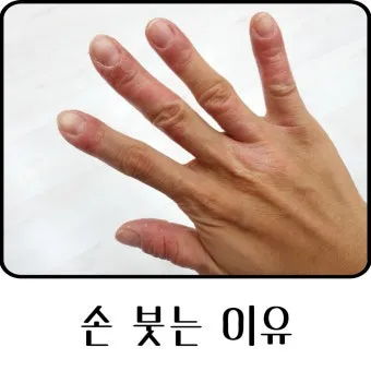 손등 붓는 이유 혈액순환 문제 증상과 해결법 정리_21