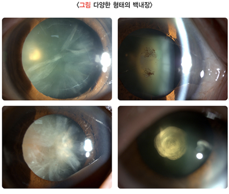 백내장 증상 2