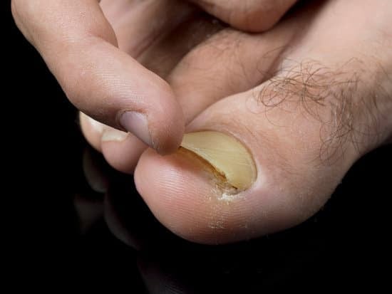 발톱 무좀 관리 방법: 효과적인 치료와 예방