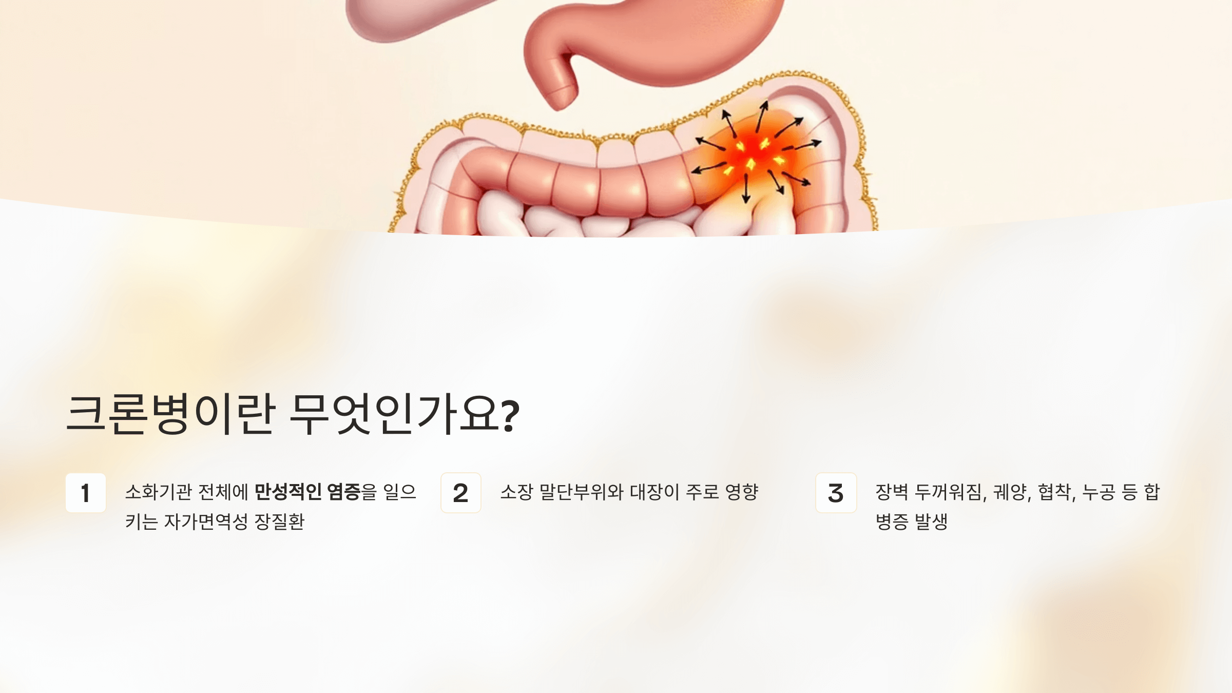 크론병 사진입니다.