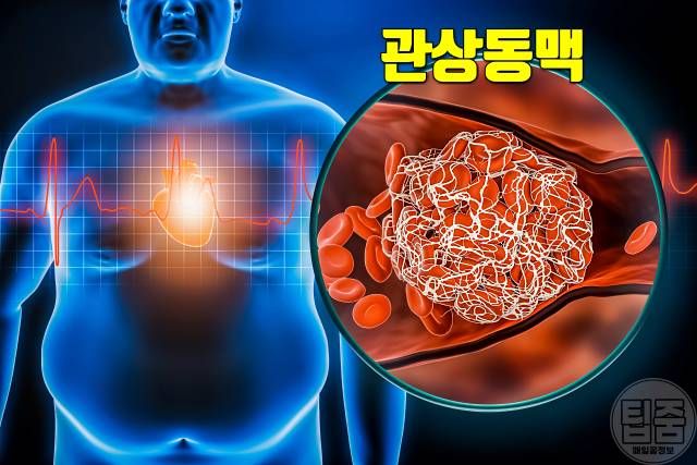 땀 많이 나는 병 다한증 원인 협심증 심근경색