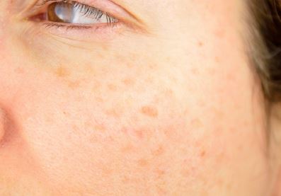 기미가 있는 얼굴