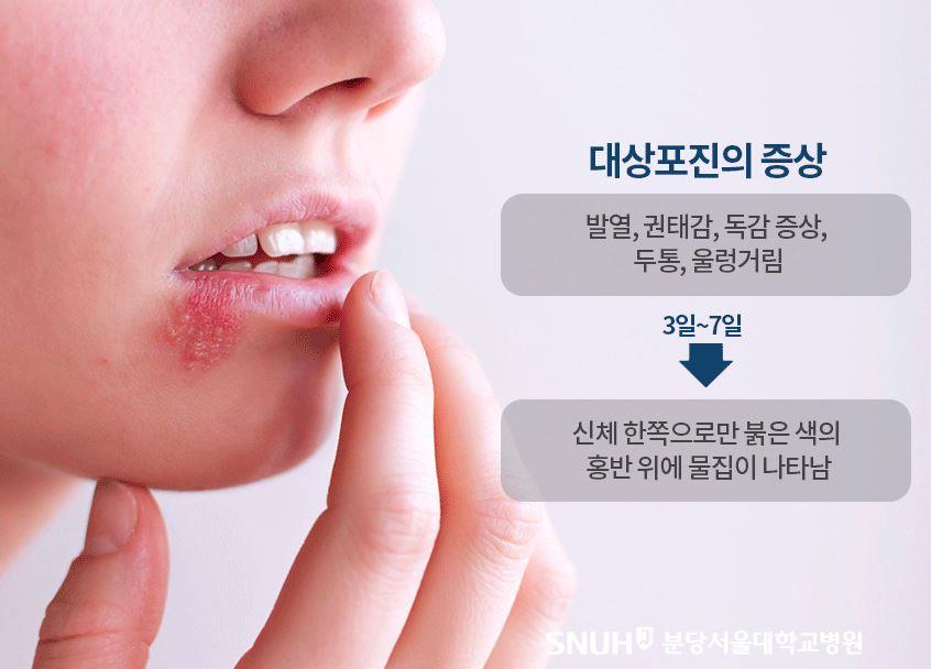  대상포진 예방