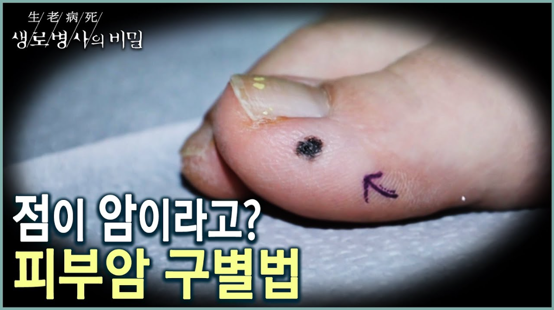 생로 병사의 비밀 악성 흑색종